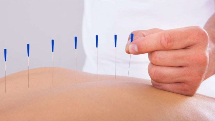 Agopuntura tecnica terapeutica